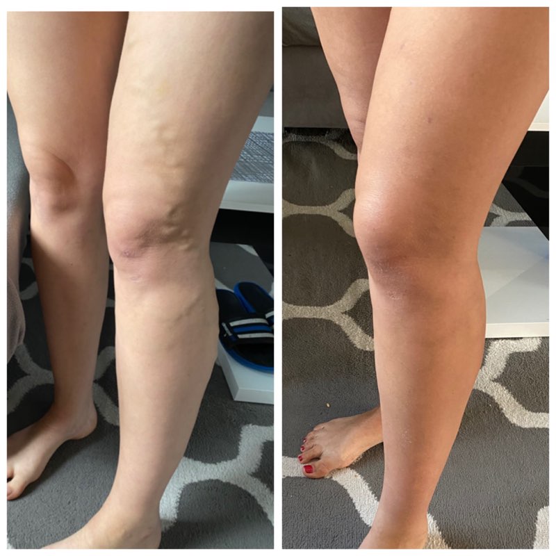 zdjęcie nogi przed i po