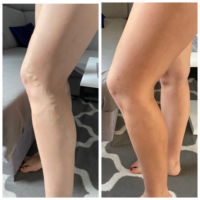 zdjęcie nogi przed i po 2